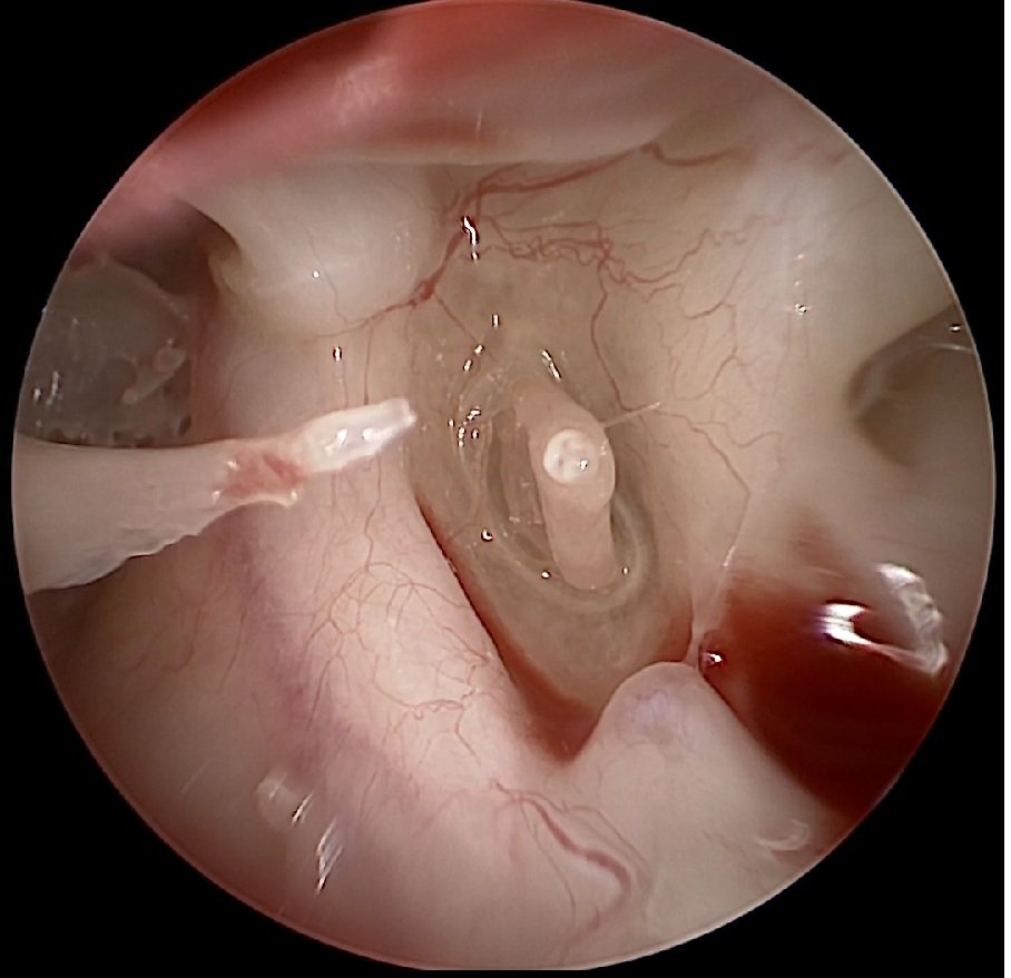Ossiculoplasty 1
